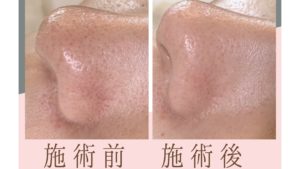 鼻スッキリ症例写真