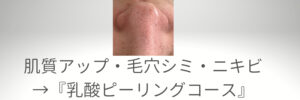 毛穴大阪エステ